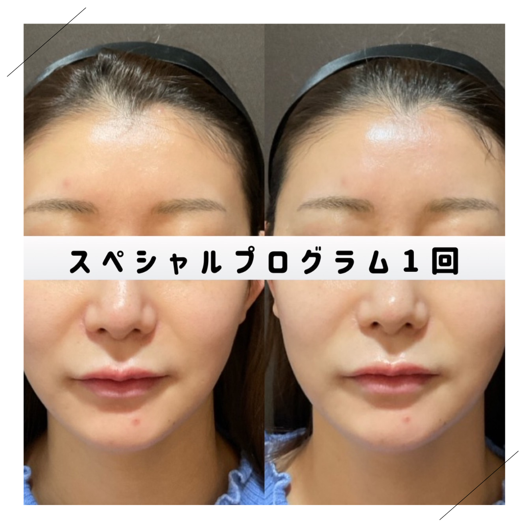 【サロンケア】ワンランク上の肌磨き